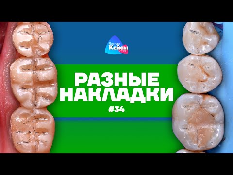 Видео: Разные накладки | Дентал Кейсы от BG #34