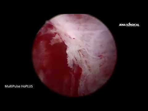 Видео: HoLEP. Гольмиевая энуклеация аденомы 75 см³.Техника.En-block. MultiPulse HoPLUS. Артем Гоняев.Тюмень