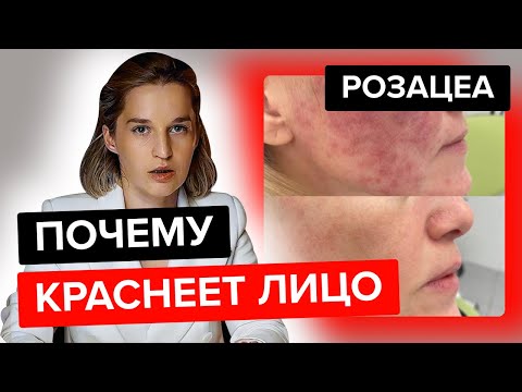 Видео: Красное лицо, розацеа! Вся информация ⚠️