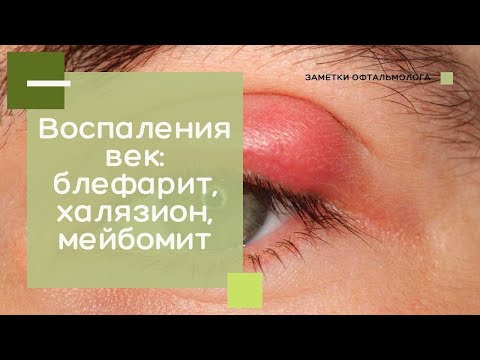 Видео: Воспаление век: блефариты, халязионы, мейбомиты