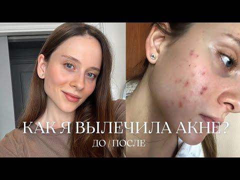 Видео: Как я вылечила акне? Питание, системные ретиноиды, уход