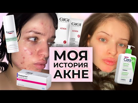 Видео: БОРЬБА С АКНЕ / роаккутан и адские побочки + фотки 💕