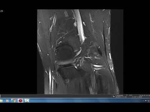 Видео: РУКОВОДСТВО ПО МРТ КОЛЕНА