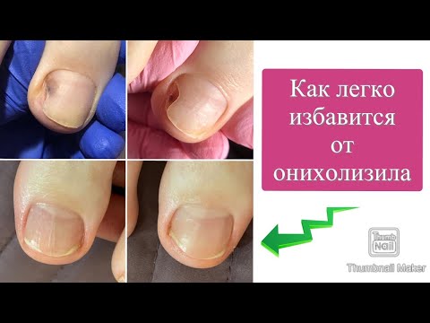 Видео: Причины онихолизиса. Как от него избавиться. Почему отслаиваются ногти. Онихолизис на ногах