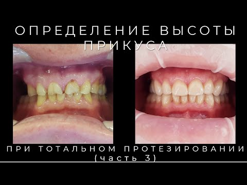 Видео: Определение Высоты Прикуса При Тотальном Протезировании на Зубах и Имплантатах