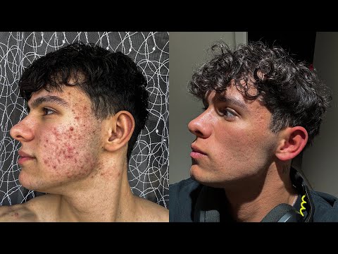Видео: Как избавиться от АКНЕ? (3 метода)