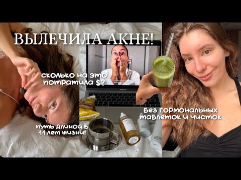 Видео: ВЫЛЕЧИЛА АКНЕ | мой путь длиной в 11 лет