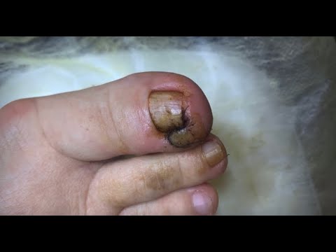 Видео: Вросший ноготь 😱🆘⚠️🦶🏻