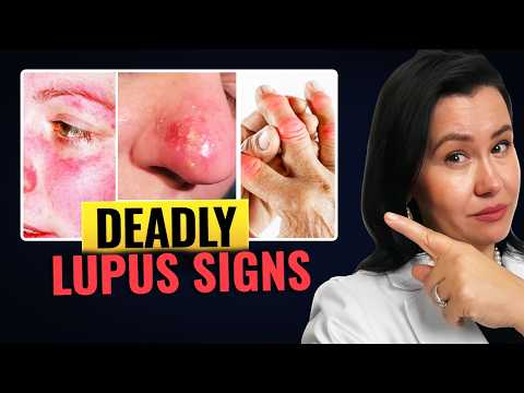 Видео: 11 СМЕРТЕЛЬНЫХ признаков волчанки, которые нельзя игнорировать