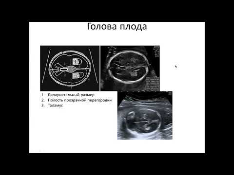 Видео: 2 скрининг: Фетометрия 03 декабря 2019