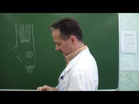 Видео: Пластика передней стенки пахового канала по Жирару-Спасокукоцкому