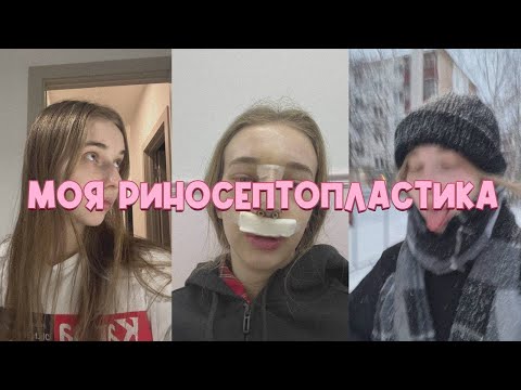 Видео: Риносептопластика моя история. Доктор Акопов Арам Артурович