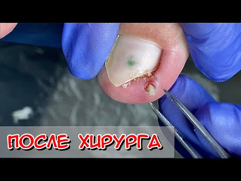 Видео: Сюрприз после хирурга /  Вросший ноготь пробил боковой валик / Удаления вросшего ногтя у хирурга