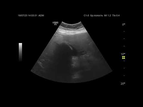 Видео: Ультразвуковая диагностика. Доктор Иогансен. Видеопримеры. Выпуск 28. Камни желчного пузыря (2).
