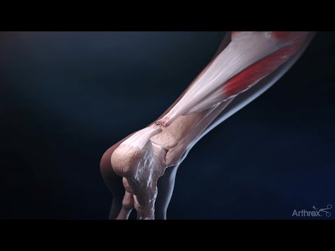 Видео: Хирургическая техника SpeedBridge™ для ахиллова сухожилия