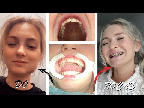 Видео: Сколько стоит поставить брекеты? Жизнь с брекетами до/после