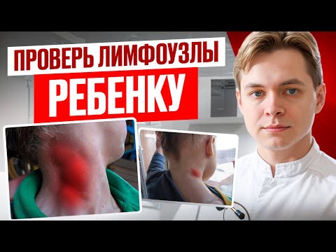Видео: Увеличенный Лимфоузел у ребенка. 6 Симптомов Рака лимфоузла. Как обследовать лимфоузел.