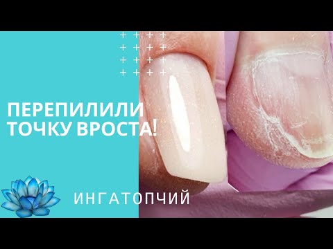 Видео: Точка вроста ногтя! Как восстановить. Ошибки в маникюре #10