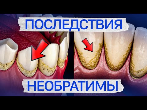 Видео: ВСЁ о зубных камнях простыми словами за 12 МИНУТ
