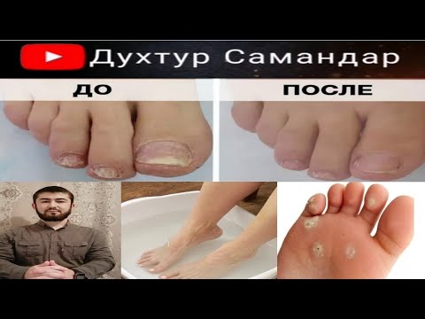 Видео: Грибоки пой ва нохунхо! Табобати пурра ва рохи пешгири и он.