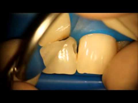 Видео: Препарирование ультразвуком Сапелюк Андрей Woodpecker E9