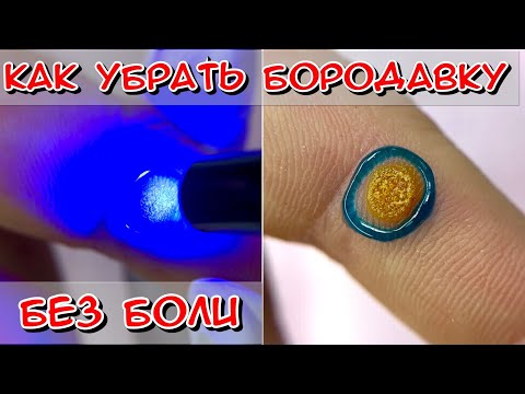 Видео: Бородавка на пальце / Как выглядит бородавка? / Как лечить бородавку? / Что такое бородавка? ВПЧ