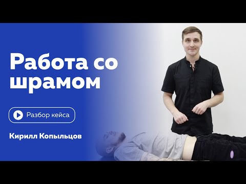 Видео: Работа со шрамом. Клинический разбор от Кирилла Копыльцова