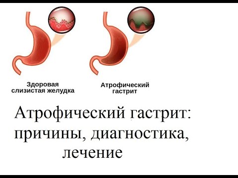 Видео: Атрофический гастрит: причины, диагностика, лечение