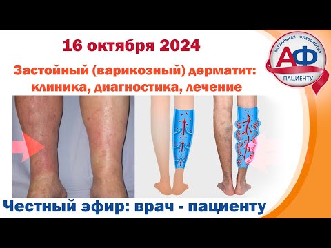 Видео: Застойный варикозный дерматит  клиника, диагностика, лечение