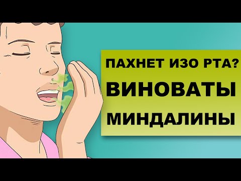 Видео: ХАЛИТОЗ И ТОНЗИЛЛИТ: КАК СВЯЗАНЫ И КАК ЛЕЧИТЬ?