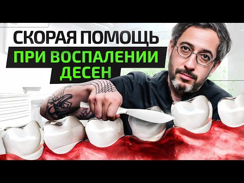 Видео: Почему кровоточат десны при чистке зубов. Что делать?