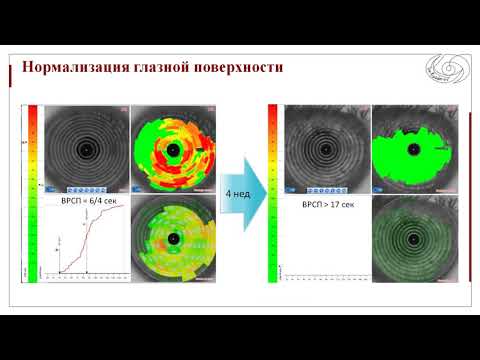 Видео: Секция "Новые подходы в рефракционной хирургии и лечении патологии роговицы"