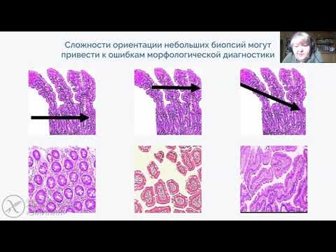 Видео: Обязательна ли биопсия для диагностики целиакии?