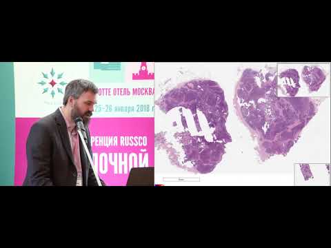 Видео: Диагностические сложности: редкие опухоли РМЖ. Клинический случай 1