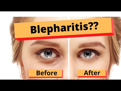 Видео: Блефарит. Как лечить блефарит. Лучшее домашнее лечение.