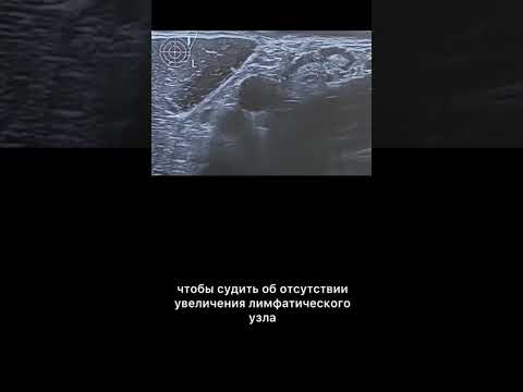 Видео: #узи #аксиллярныйлимфоузел