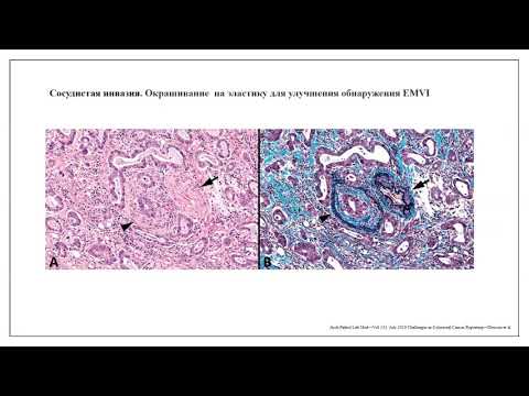 Видео: Опухоли пищеварительной системы ВОЗ 2019: колоректальный рак (Ивко О.В.)