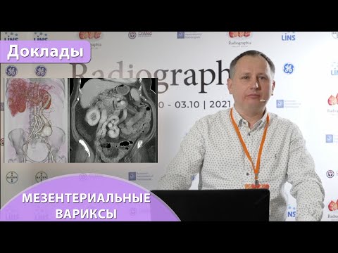 Видео: Мезентериальные вариксы -  terra incognita. Андрей Мангов