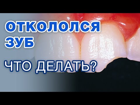 Видео: Что делать если ОТКОЛОЛСЯ кусок зуба? / Откололся зуб: как восстановить?