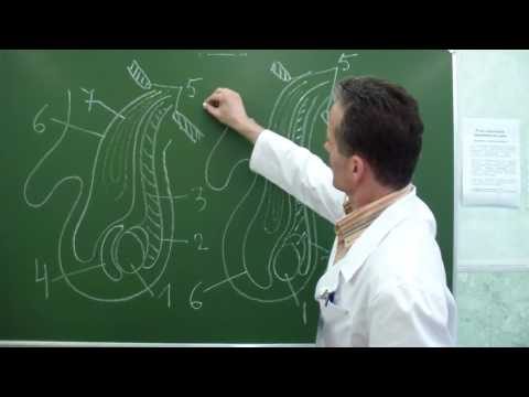 Видео: Схемы приобретенной, врожденной и скользящей паховых грыж