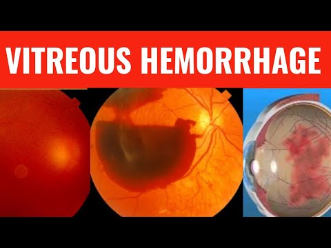 Видео: Кровоизлияние в стекловидное тело || Всё, что вам нужно знать