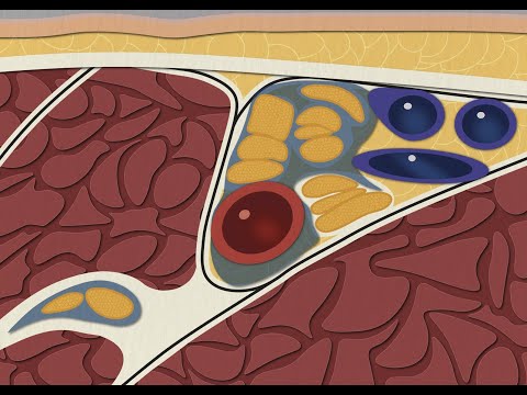 Видео: Подмышечная блокада под УЗИ | Техника 4 нервов: как найти "беглеца"?