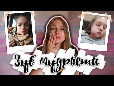 Видео: Моя история удаления зуба мудрости