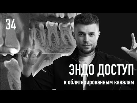 Видео: Эндодонтический доступ к облитерированным каналам. Дмитрий Николаев. Уроки эндодонтии. Выпуск 34