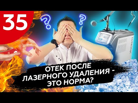 Видео: Отек после лазерного удаления - это норма?