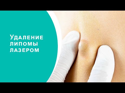 Видео: Удаление липомы лазером