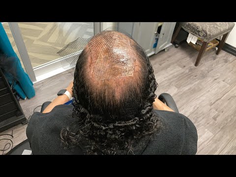 Видео: Как наращивать волосы, если у вас алопеция