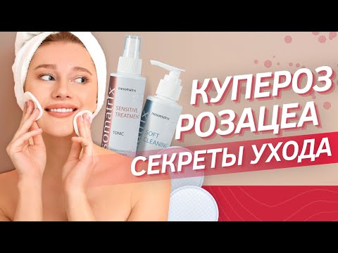 Видео: КУПЕРОЗ и РОЗАЦЕА особенности ухода за чувствительной кожей | Современные способы коррекции