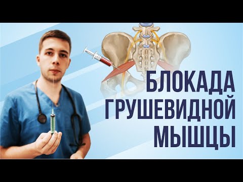 Видео: Лечебная БЛОКАДА при синдроме грушевидной мышцы и защемлении седалищного нерва