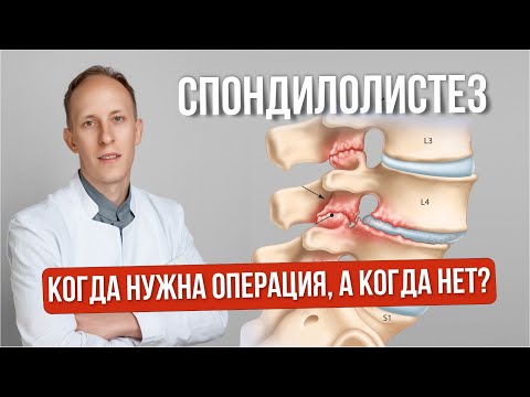 Видео: Спондилолистез. Обзор методов лечения